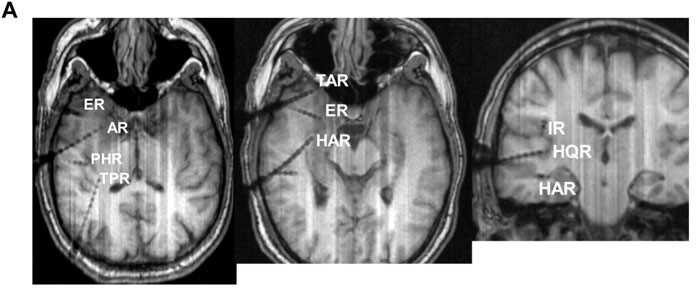 Physiological and pathological neuronal connectivity in the living human brain based on intracranial EEG signals: the current state of research